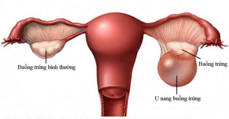 U nang buồng trứng: Triệu chứng, chẩn đoán và điều trị