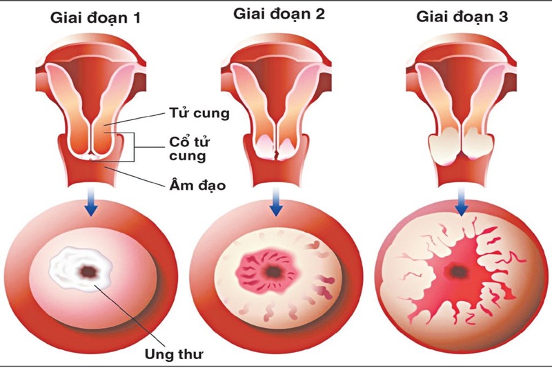 Ung thư cổ tử cung – Chẩn đoán và điều trị