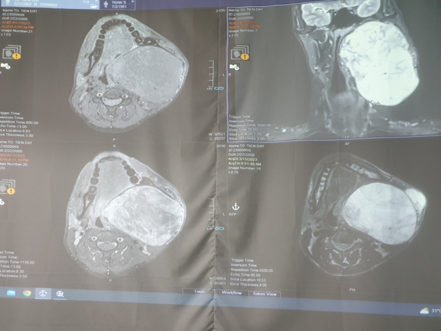 Hình ảnh khối u của Tiến Đạt phát triển lớn chèn lên xương hàm