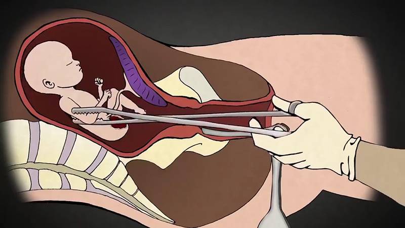 Nong - nạo gắp thai được áp dụng cho thai từ 13 - 18 tuần tuổi