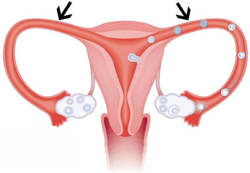 Tắc vòi trứng là bệnh phụ khoa gây vô sinh ở nữ