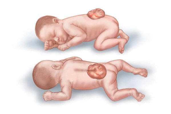 Dị tật thai nhi là những bất thường trong quá trình thai nhi hình thành và phát triển