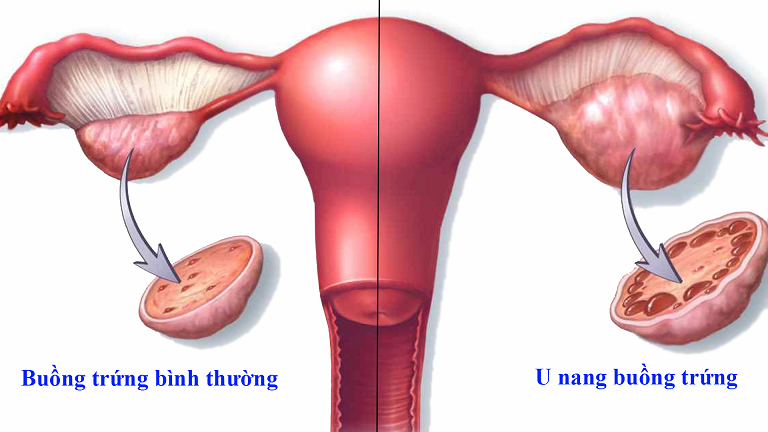 U nang buồng trứng là căn bệnh thường gặp ở phụ nữ