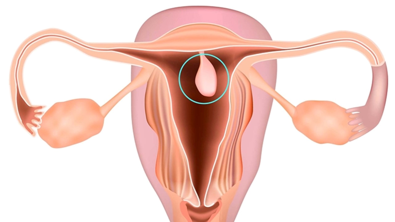 Polyp cổ tử cung là căn bệnh khá phổ biến ở phụ nữ