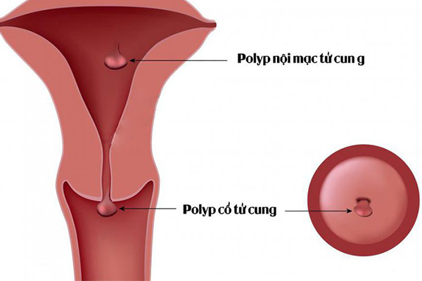 Polyp tử cung thường có cuống và dễ chảy máu khi chạm vào