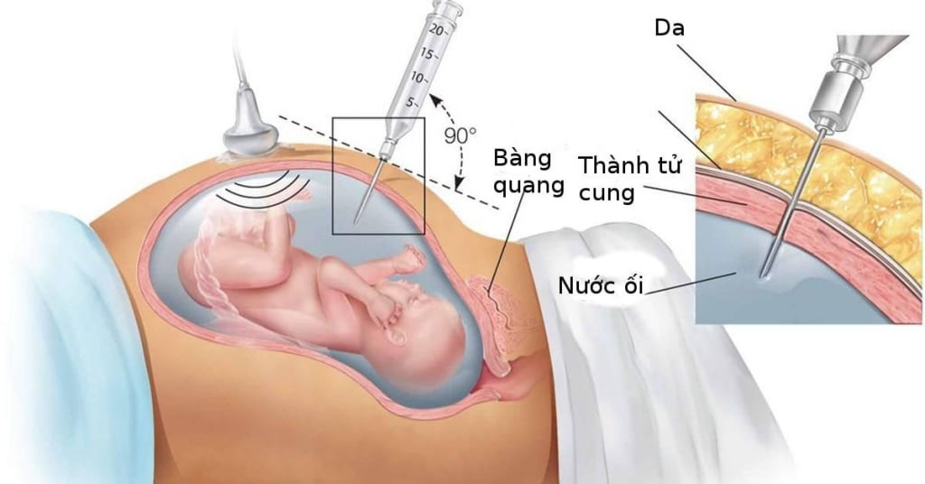 Phương pháp xét nghiệm ADN xâm lấn gây nhiều nguy cơ cho mẹ và thai nhi