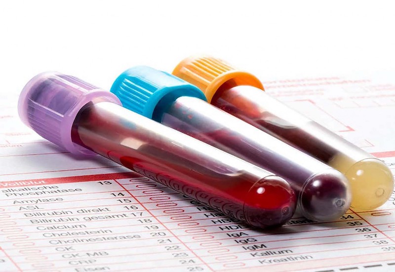 Kiểm tra máu tổng quát bao gồm nhiều xét nghiệm các chỉ số