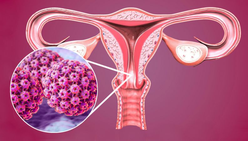 Virus HPV là nguyên nhân chính gây nên ung thư cổ tử cung