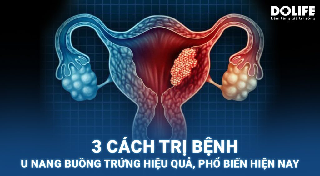 3 cách trị bệnh u nang buồng trứng hiệu quả, phổ biến hiện nay