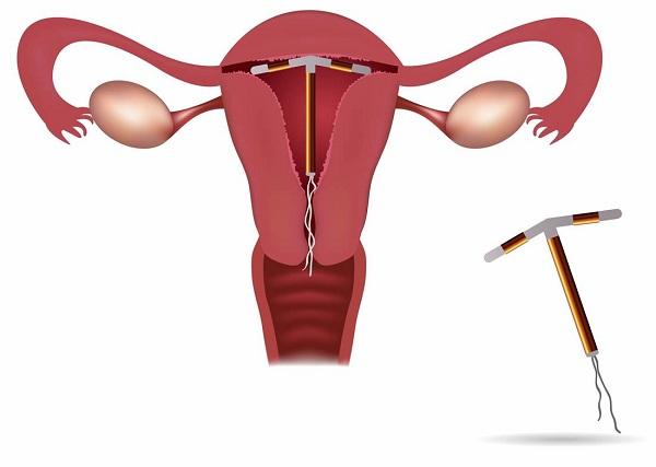 Vòng tránh thai có một số hạn chế và chống chỉ định nhất định