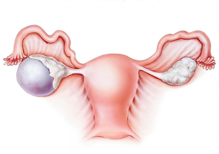 Đa u nang buồng trứng là dạng rối loạn nội tiết tố thường gặp ở chị em phụ nữ