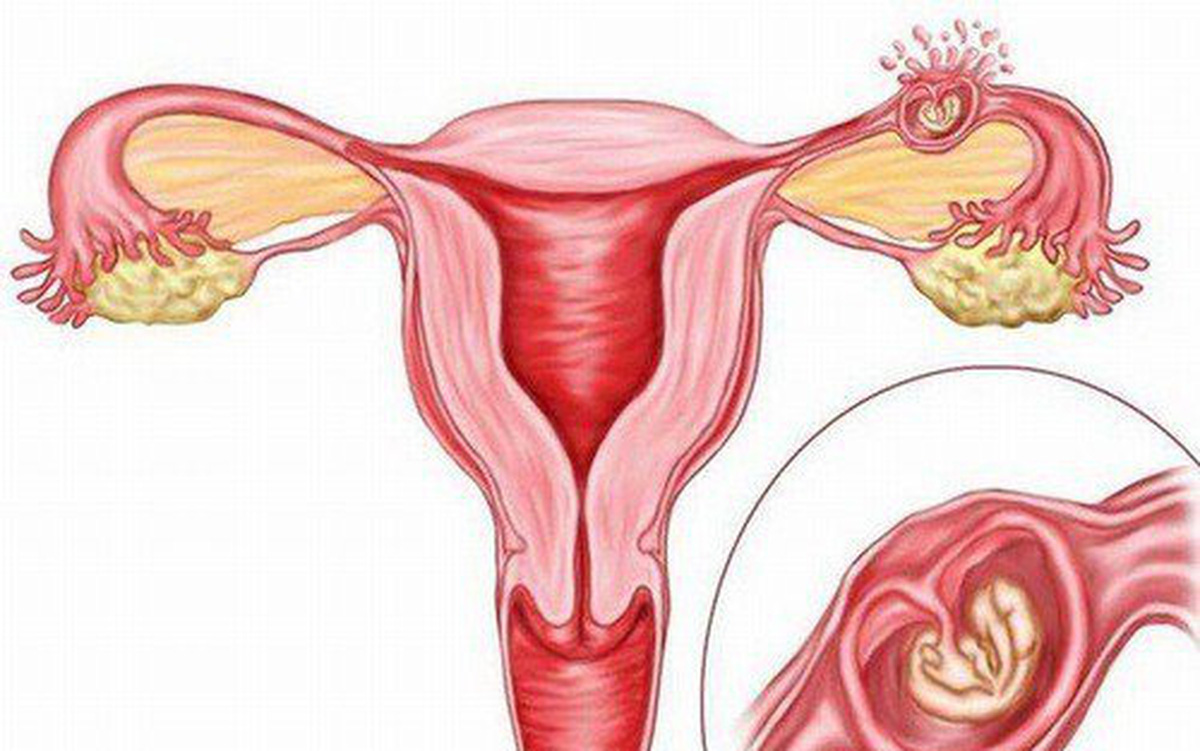 Mang thai ngoài tử cung không phải là hiện tượng quá hiếm gặp