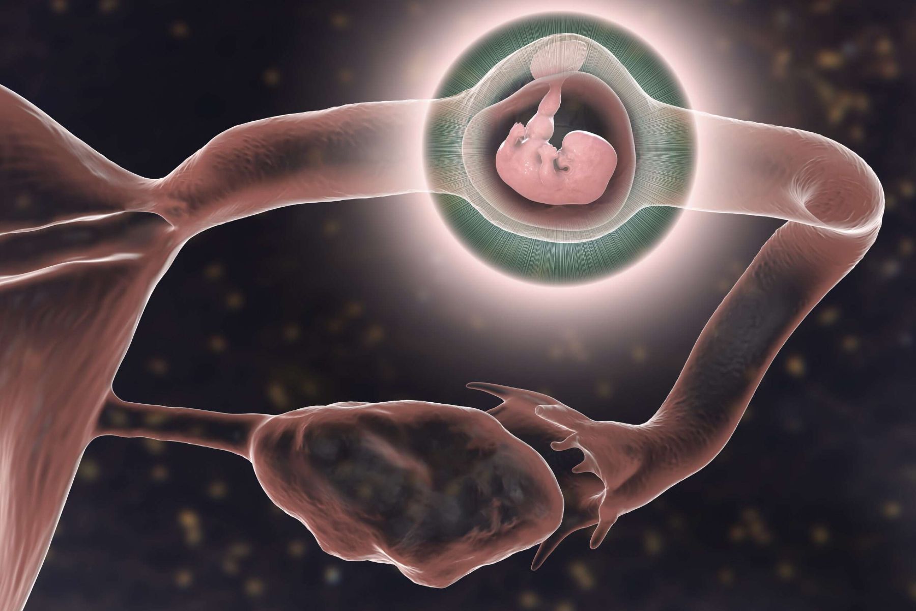 95% trường hợp thai ngoài tử cung nằm ở vòi trứng