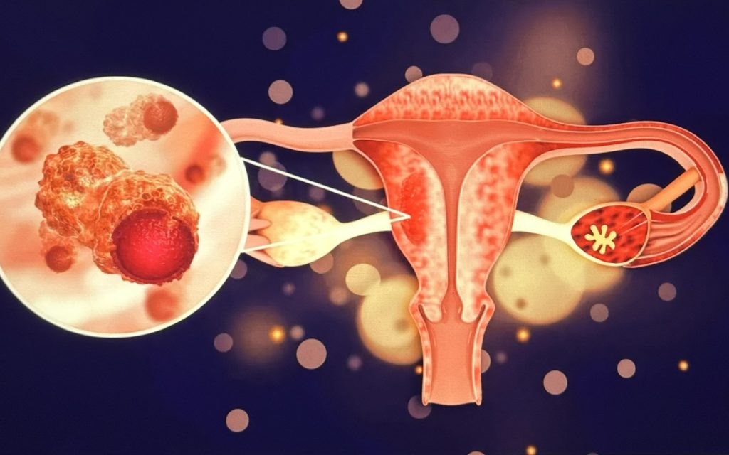 Ung thư buồng trứng là căn bệnh phổ biến có thể gặp ở bất cứ chị em nào