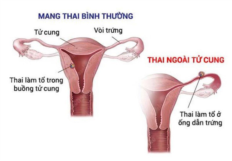 Thai ngoài tử cung có thể làm tổ ở vòi tử cung, góc tử cung hoặc kẽ tử cung