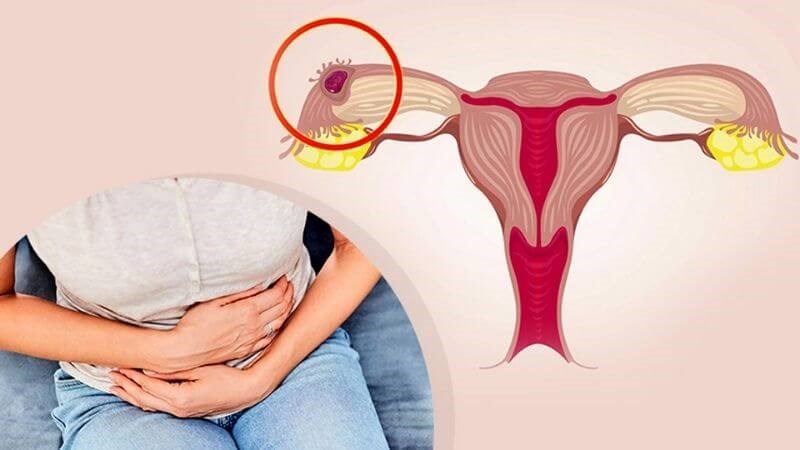 Thai ngoài tử cung gây ra những cơn đau bụng bất thường