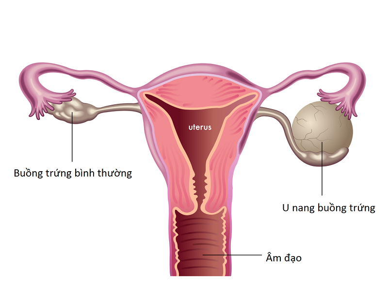 Các dấu hiệu của u nang buồng trứng thường chỉ xuất hiện khi khối u đã lớn