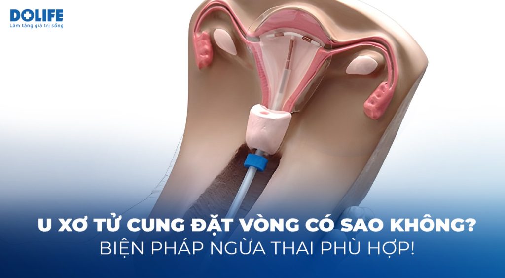 U xơ tử cung đặt vòng có sao không? Biện pháp ngừa thai phù hợp!