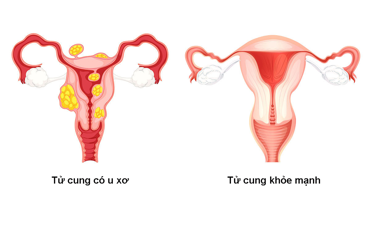 U xơ tử cung là bệnh lý được đánh giá lành tính của tử cung.