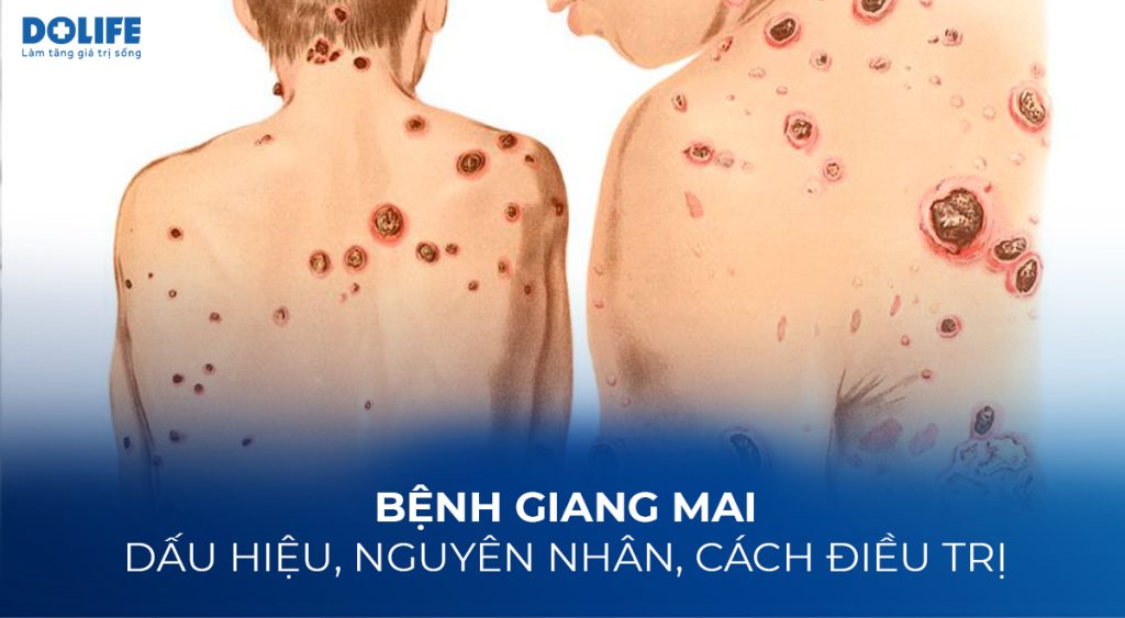 Bệnh giang mai: Dấu hiệu, nguyên nhân, cách điều trị 