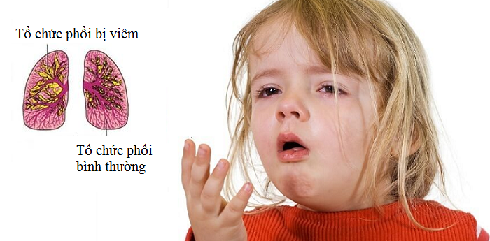 Biến chứng khó lường của bệnh viêm phổi ở trẻ