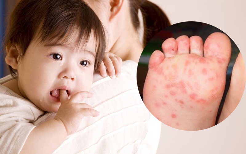 Trẻ bị tay chân miệng cần được cách ly để hạn chế virus lây lan