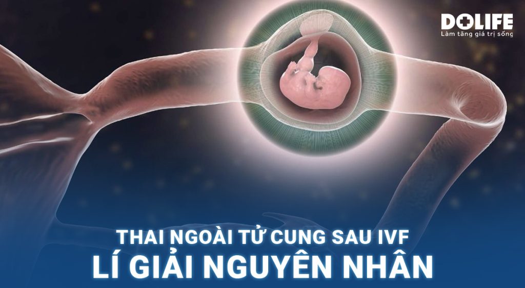 Thai ngoài tử cung sau IVF: Lý giải nguyên nhân 