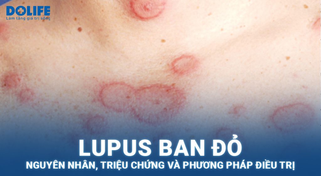 Lupus ban đỏ: Nguyên nhân, dấu hiệu nhận biết và cách điều trị