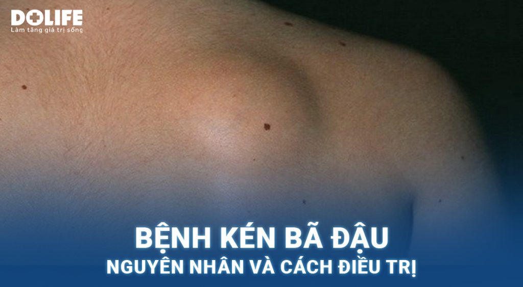 Kén bã đậu: Nguyên nhân và cách điều trị