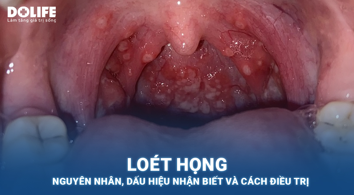 Nối Từ Họng: Khái Niệm và Ứng Dụng Trong Cuộc Sống