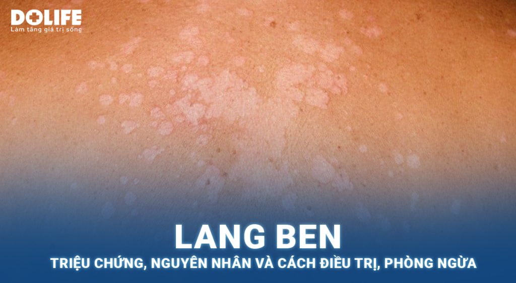 Lang ben: Triệu chứng, nguyên nhân và cách điều trị, phòng ngừa