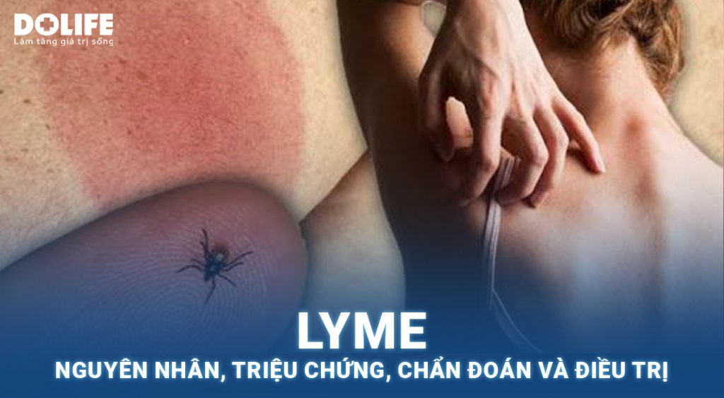 Lyme: Nguyên nhân, triệu chứng, chẩn đoán và điều trị
