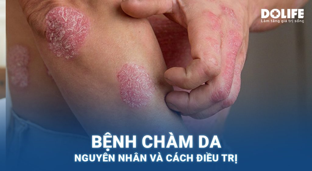 Chàm da (Eczema): Nguyên nhân, biểu hiện và phương pháp điều trị