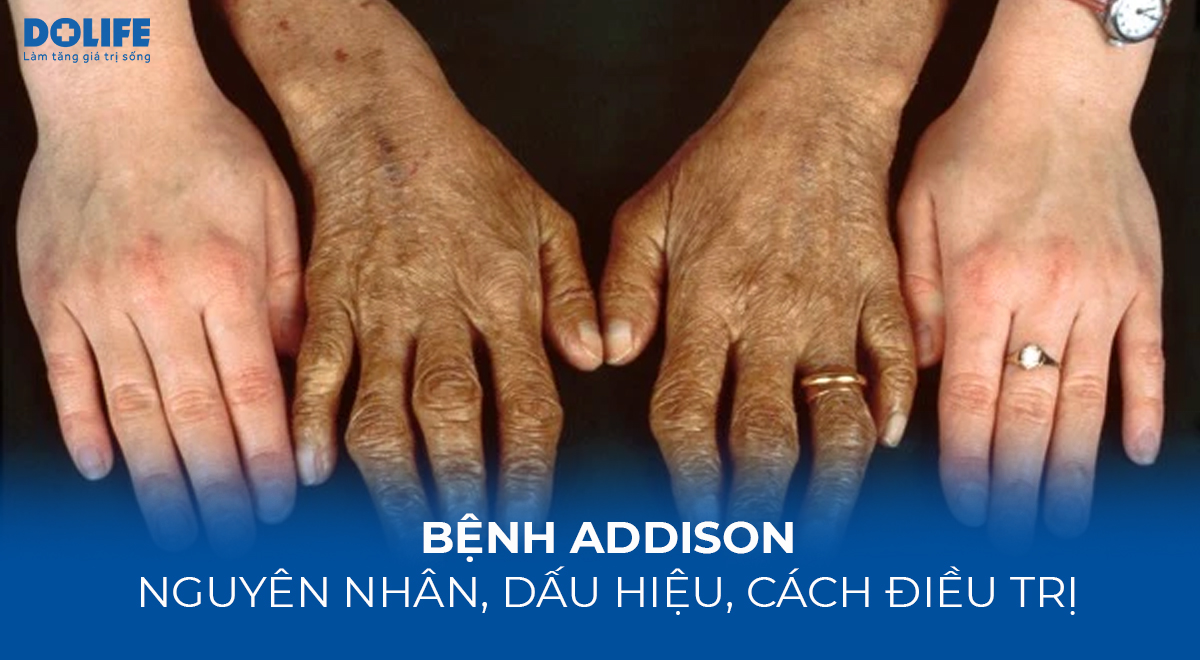 Chẩn đoán Bệnh Addison