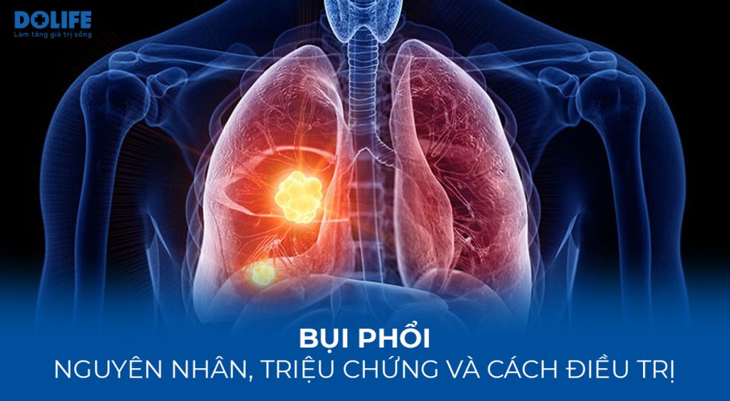 Bụi phổi: Nguyên nhân, triệu chứng và cách điều trị