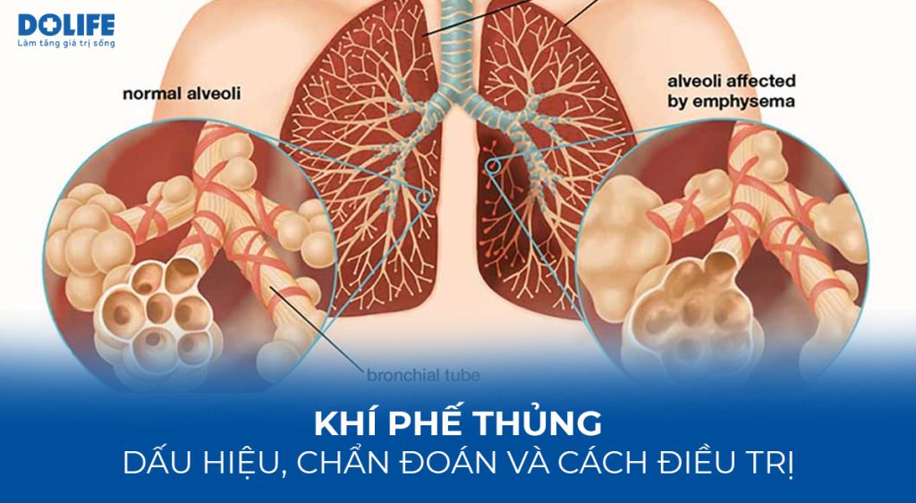 Khí phế thũng: Dấu hiệu, chẩn đoán và cách điều trị