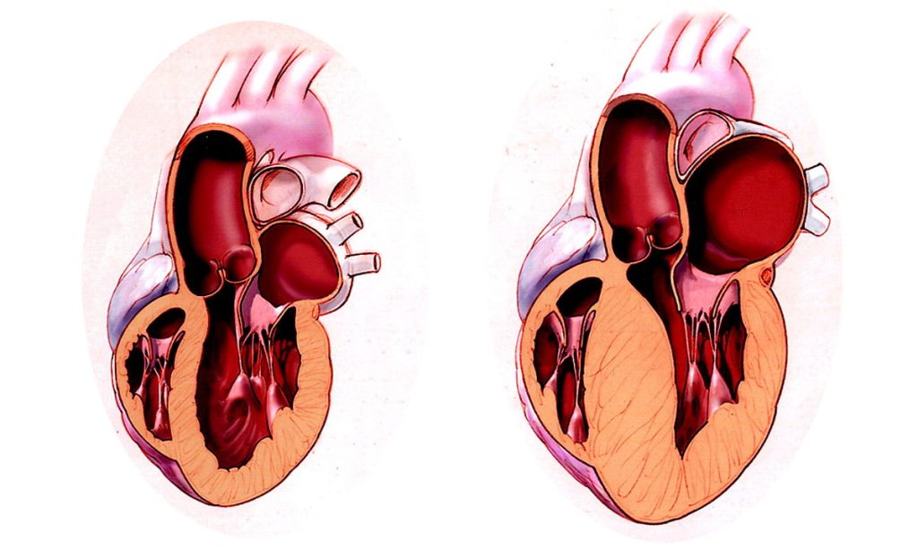 Bệnh cơ tim phì đại hiểu đơn giản là tình trạng rối loạn cơ tim, khiến cho tim giảm khả năng co bóp lưu thông máu, từ đó gây rối loạn nhịp tim.