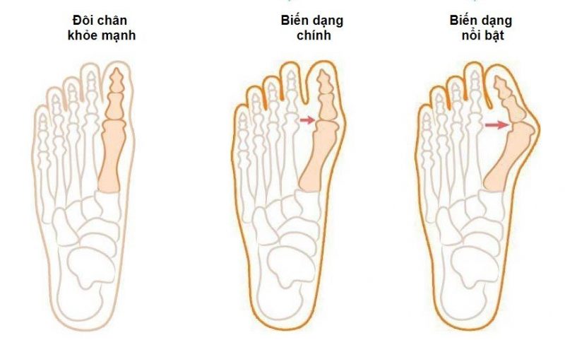 Các dạng biến dạng ngón chân cái