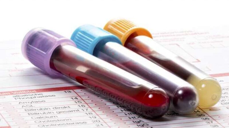 Xét nghiệm công thức máu để đánh giá về số lượng tiểu cầu, bạch cầu hoặc hồng cầu (nếu như có bị nhiễm trùng máu). 