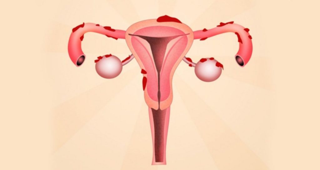 Lạc nội mạc tử cung là bệnh phụ khoa ở nữ giới, thường phát triển ở ngoài buồng tử cung hay một số vị trí ở trong vùng chậu.