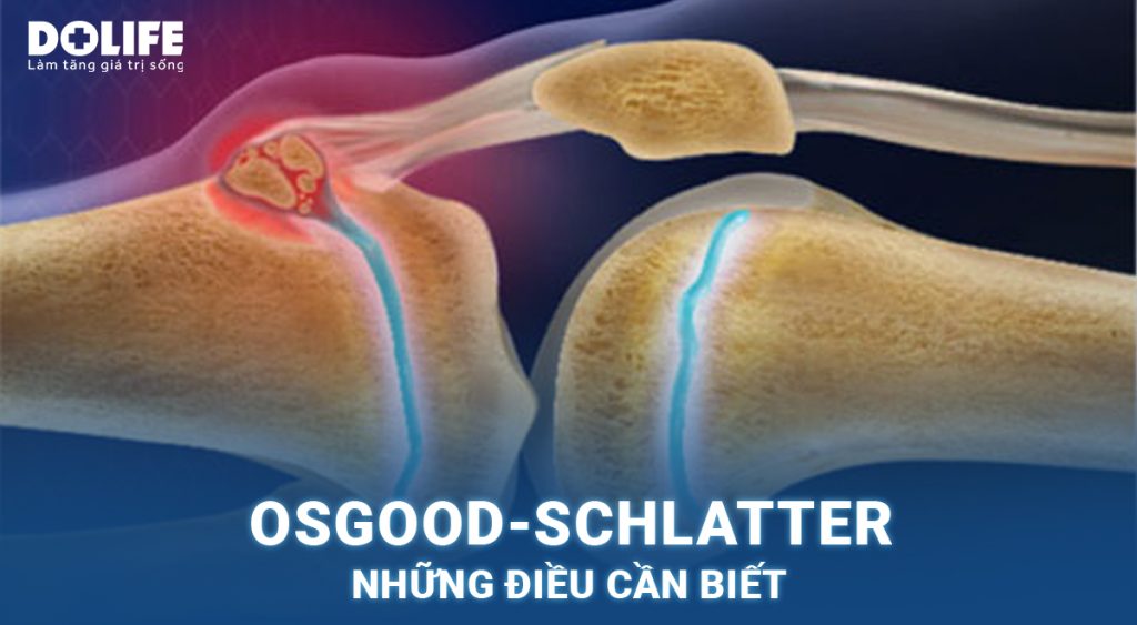 Osgood-Schlatter (viêm lồi củ trước xương chè): Những điều cần biết