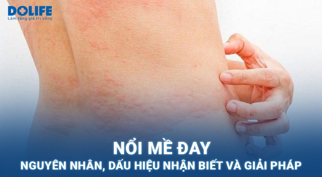 Nổi mề đay: Nguyên nhân, dấu hiệu nhận biết và giải pháp