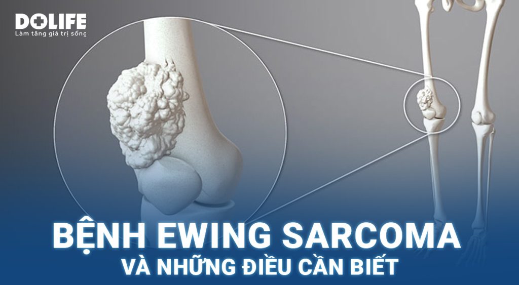 Ewing sacroma: Nguyên nhân, triệu chứng và phương pháp điều trị