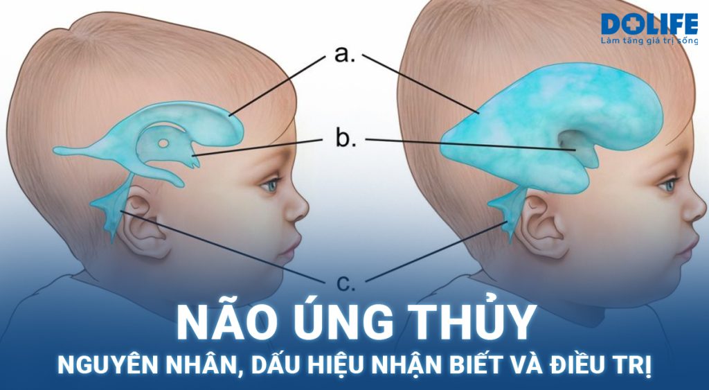 Não úng thủy: Nguyên nhân, dấu hiệu nhận biết và điều trị