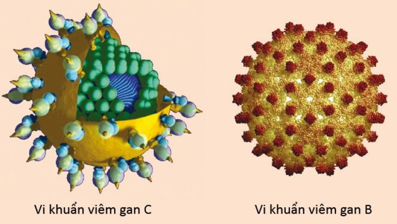Virus viêm mãn tính B hoặc C là một trong những nguyên nhân gây bệnh.