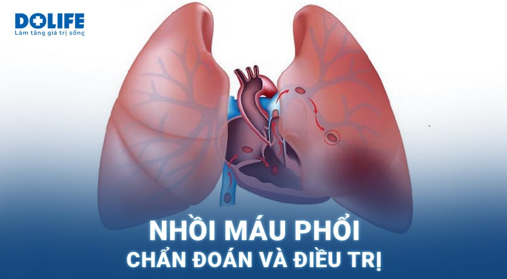 Nhồi máu phổi: Chẩn đoán và điều trị
