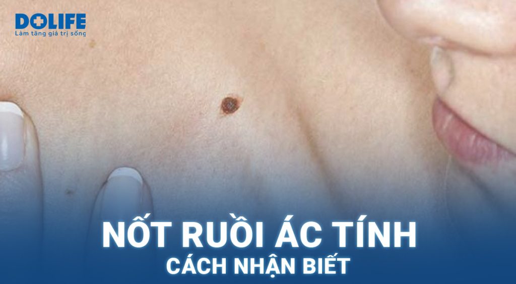 Nốt ruồi ác tính: Cách nhận biết!