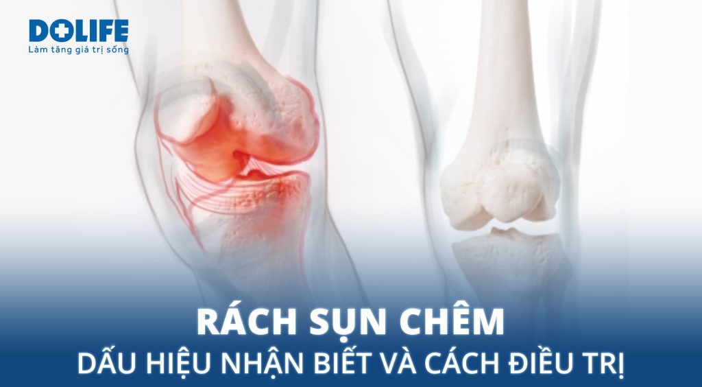 Rách sụn chêm: Dấu hiệu nhận biết và cách điều trị