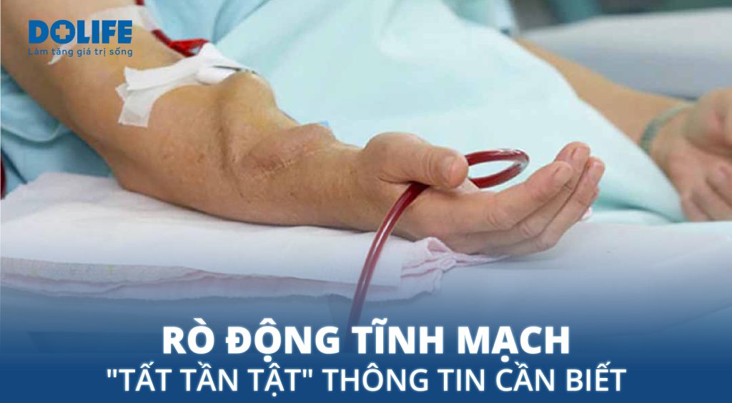 Rò động tĩnh mạch : Nguyên nhân, triệu chứng và phương pháp điều trị