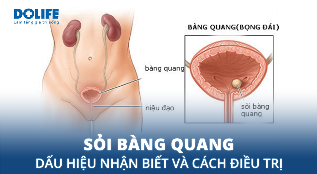 Sỏi bàng quang: Dấu hiệu nhận biết và cách điều trị